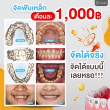 จัดฟันเดือนละ 1000